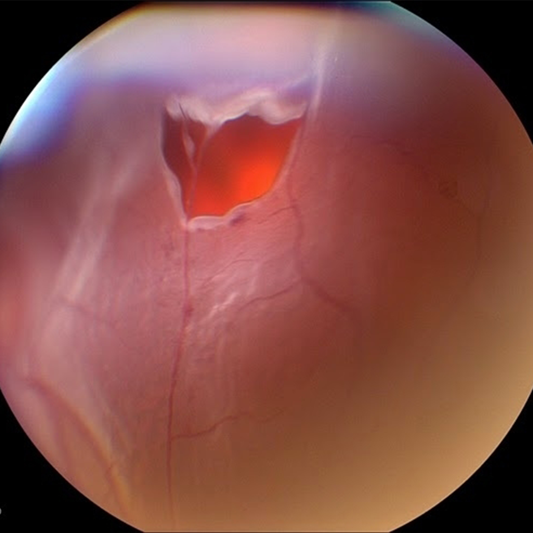 What is Myopia?